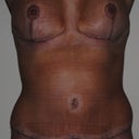 6 weeks post-op