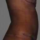 6 weeks post-op