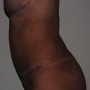 6 weeks post-op