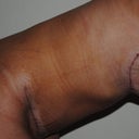 6 weeks post-op