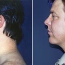Chin Augmentation