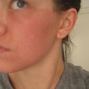 11 days since fraxel Re:pair.  Less red (easily covered with makeup now), sorry the photo is a little fuzzy