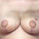 3 weeks post op