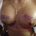 The day after sugery.
