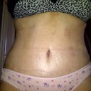 20 days after surgery