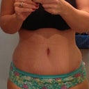 Almost 5 weeks post-op
