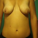 Pre op-Front view