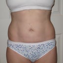 After-Approx. 2 mos.