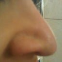 oct 2011 - see how the tip drops and it looks wide - why did this happen? this is after having the first surgery in 2008 and then another where he put a graft in 2008