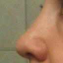 nov 2011 - one week after 3rd surgery. i like how the nose looks from the side view and my tip looks more defined. but over time it changes and starts to drop :(