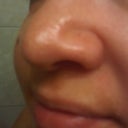 sept 2012 - took this 2 months ago. notice how my tip looks more round and bulbous again and is starting to drop again. :( this pic was taken almost a year after 3rd surgery.