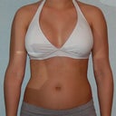 1 week After BA