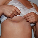 My beautiful Insicion ;-) 1 week After BA