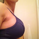 Side view.  I love my higher projection implants