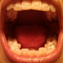 With Aligners in. I have a lot of attachments but I don't even notice them myself really. I like them. Better than metal.