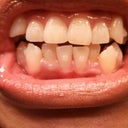 Without trays. You can see a few attachments a little bit. They are so small. They look bigger on the aligners to fit them.