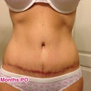 My scar is thicker in middle because of opening & spitting stitches. But, I'm ok w/ it.
