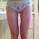 4 days post - lower leg swelling!!