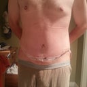 Post Op Day #2