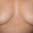 6 months after explant