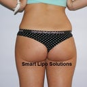 This is me just before smartlipo treatment