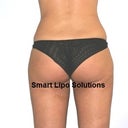 One month after my smartlipo! I loved the result!