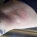 1st Treatment - Day 1 - Right Arm