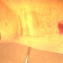 1st Treatment - Day 2 - Right Arm