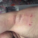 1st Treatment - Day 2 - Left Arm