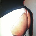 1 day post op!!