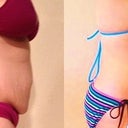 Right Side 05/19/2013 Before and After