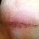 Week 4 close up of stomach incision