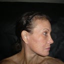 3 months post op, no makeup, age 53