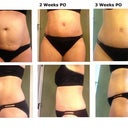 Comparison: 4 Days Before TT > 2 WK PO > 3 WK PO.