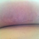 view from underneath.... scar is nice and small