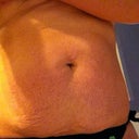pre op front view for stretch marks