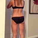 1 year from surgery
