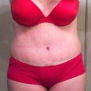 Day 19- suprised to find a little shape to my waist but look at my swollen vajayjay. Everything below bb is a swollen mess
