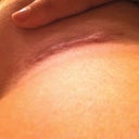 Apparently I forgot to post this from around my 2 or 3 month mark- here's how the scar looked then. That's something I was really concerned about before surgery. No one wants scars!!!
