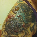 I think this was day four after treatment. Huge blisters! They got a little bigger than this at one point.