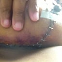 Bruising