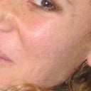 Not the best profile but I tried to find something to show how clear my cheek was before Fraxel.