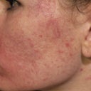 Here is the horrible "After" photo.  You can see marks from the suction that was on a machine they allowed me to try free for once to see if it would help get rid of the acne (they THEY gave me) but it didn't do anything other than give me those suction-marks for a couple days.  Fraxel sucks.