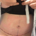 Post Op Day 3 . Semi seated position at doctor's office. Very swollen down "below".