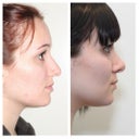 RIGHT PROFILE: before (left) and 2.5 months post-op (right)
