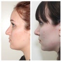 LEFT PROFILE: before (left) and 2.5 months post-op (right)