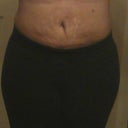 3wks after still have some hard spots