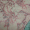 one day after my 8th treatment.