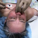 Injecting fat into my mouth area!