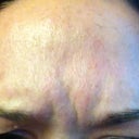me frowning, one month after initial injection and before additional 10 units of botox